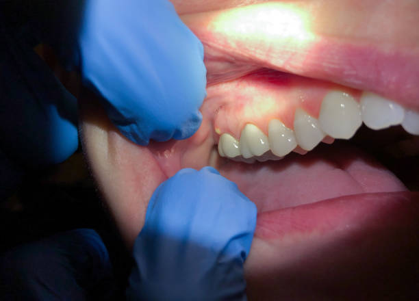 Best Emergency Treatment for Dental Infections or Abscesses in Staples, CT