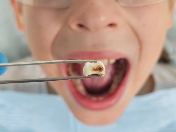 Best Emergency Treatment for Dental Infections or Abscesses in Staples, CT