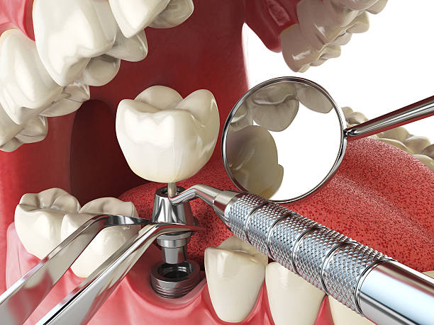 Best Emergency Dental Care for Broken or Chipped Teeth in Staples, CT